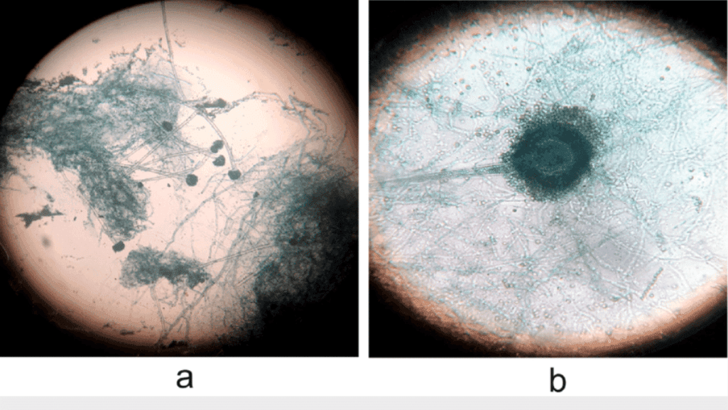 microscopic examination of vent gleet